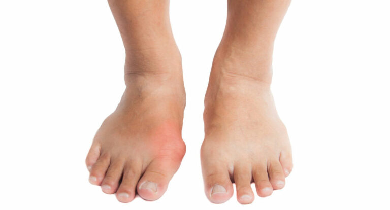 hallux valgus vanligt fotproblem